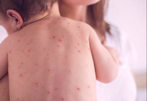 Улаанбурхан өвчнөөс сэргийлэхийг ЭМЯ-наас зөвлөлөө